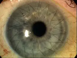 Corneal Transplant 6