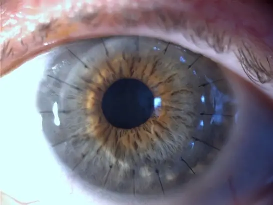 Corneal Transplant 5