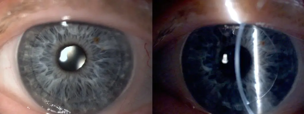 Corneal Transplant 3