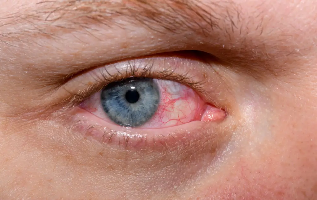 Dry Eye Disease: Causes, Symptoms, and Effective Treatments