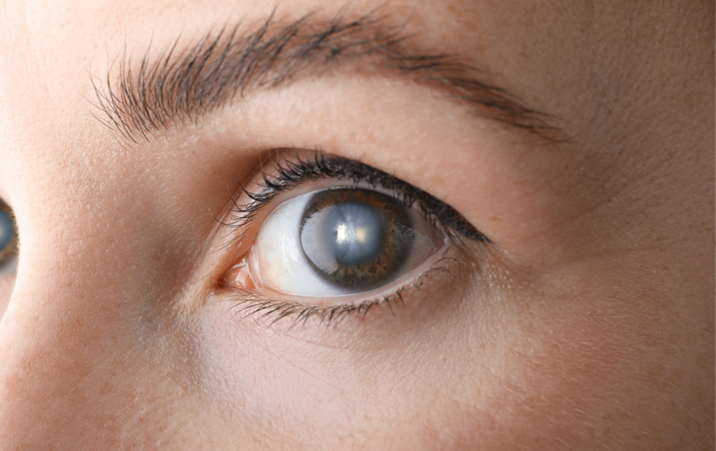 Cataracts: Unmasking the Cloudy Vision Culprit in Your Family