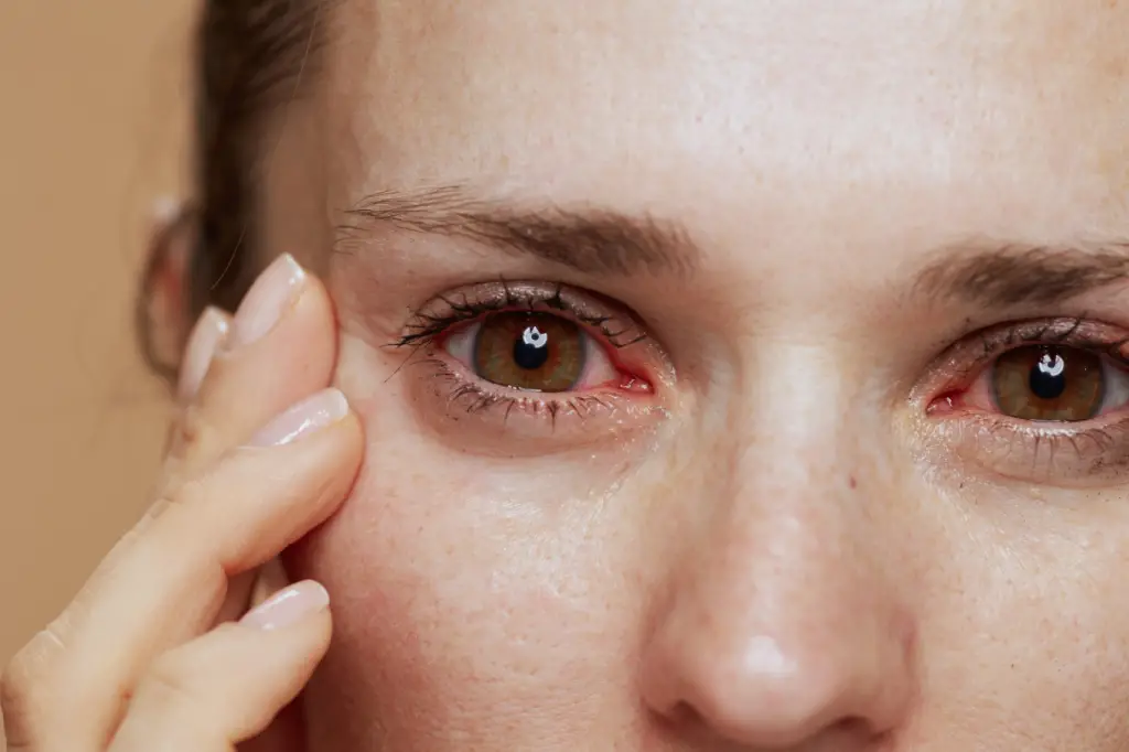 Understanding Red Eye Causes, Symptoms, and Treatments