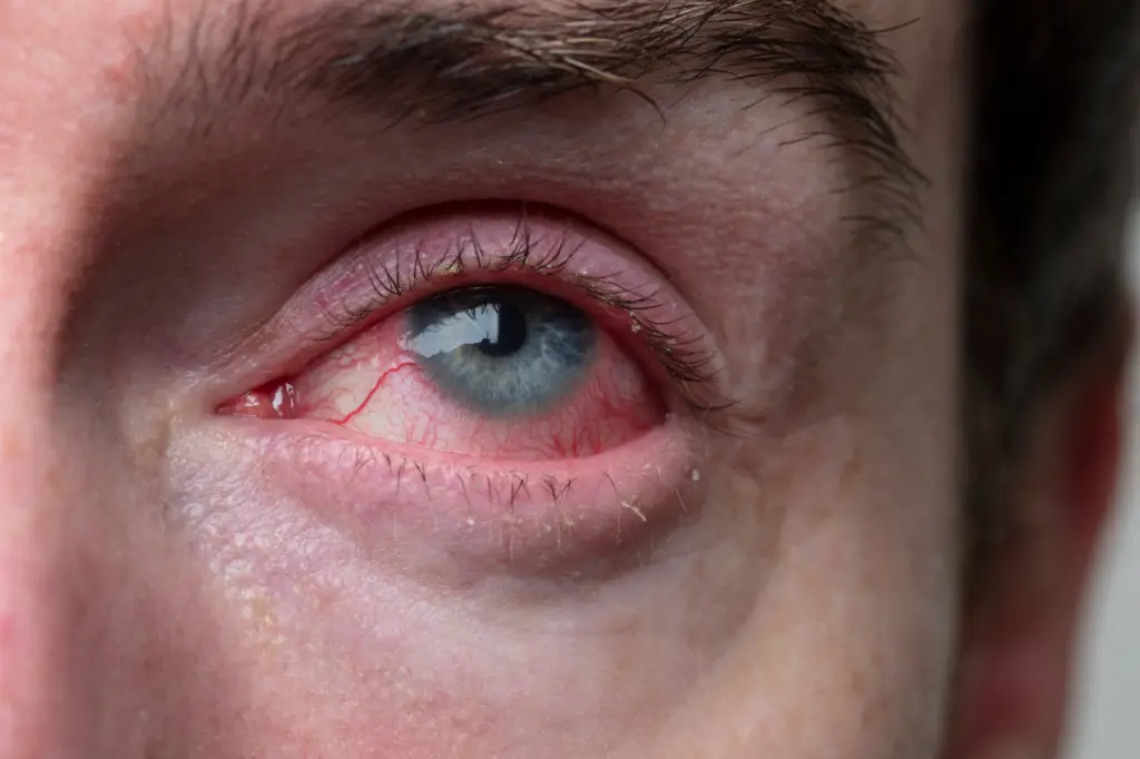 Why Do I Have Bloodshot Eyes? Common Causes and Remedies