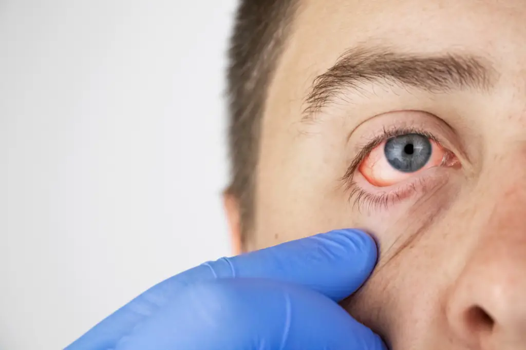 Pink Eye & Eyelid Causes, Symptoms, and Treatment Options