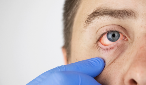 Pink Eye & Eyelid Causes, Symptoms, and Treatment Options