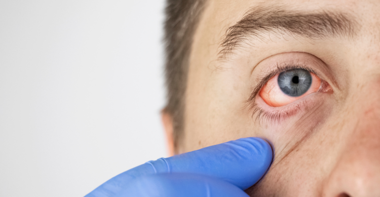 Pink Eye & Eyelid Causes, Symptoms, and Treatment Options