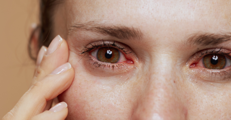 Understanding Red Eye Causes, Symptoms, and Treatments