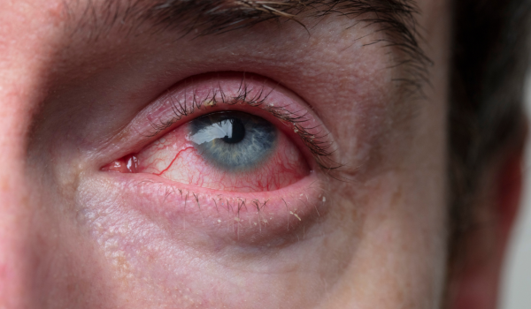 Why Do I Have Bloodshot Eyes? Common Causes and Remedies