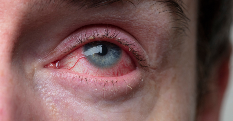 Why Do I Have Bloodshot Eyes? Common Causes and Remedies